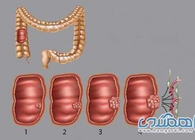آشنایی با 4 مرحله سرطان روده